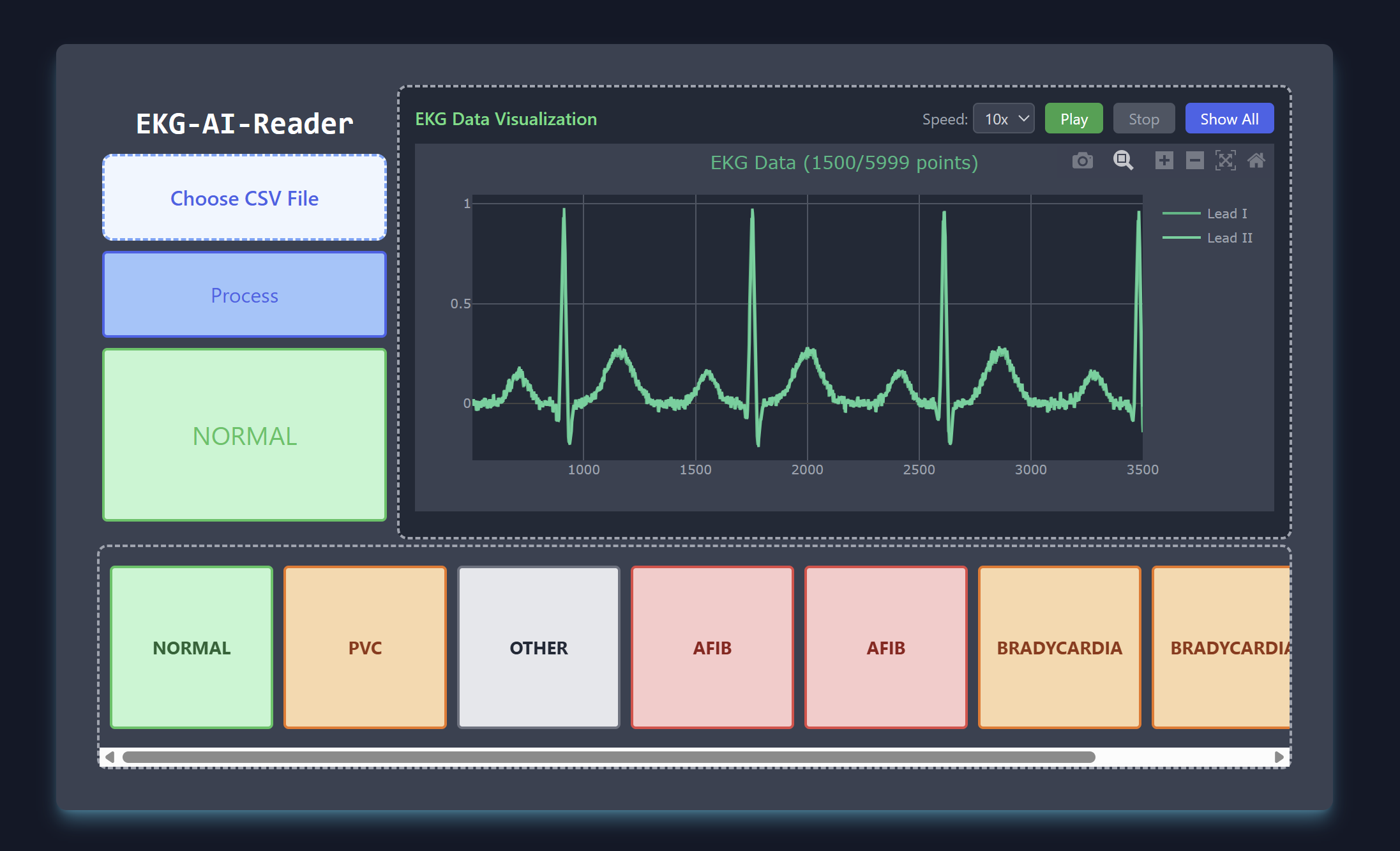 EKG AI Reader
